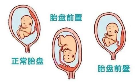 寶字 植入性胎盤
